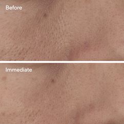 Targeted Pore Corrector, , large, image6