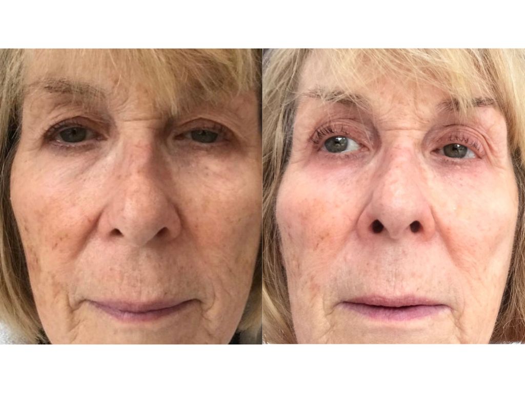 Sarah before and after La Prairie | Space NK Sarah before and after La Prairie | Space NK