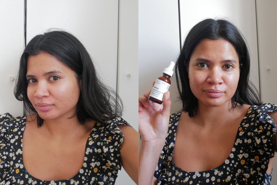 Before and after using The Ordinary Soothing and Barrier pink serum Before and after using The Ordinary Soothing and Barrier pink serum