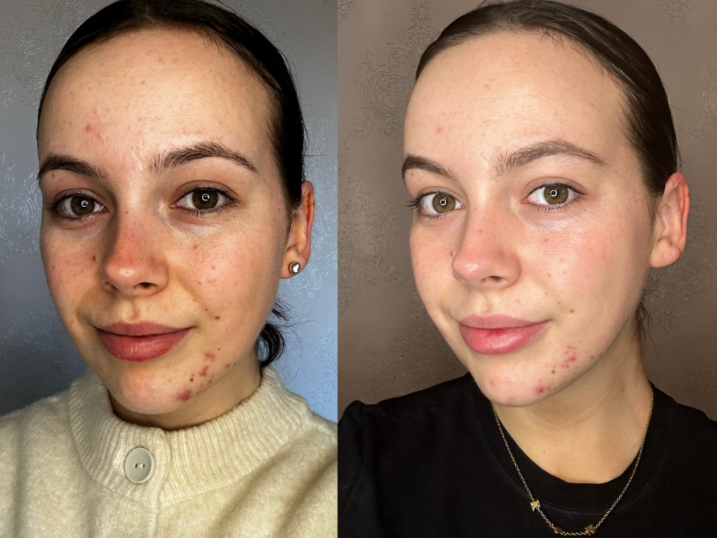 Before and after Augustinus Bader The Rich Cream | Space NK Before and after Augustinus Bader The Rich Cream | Space NK