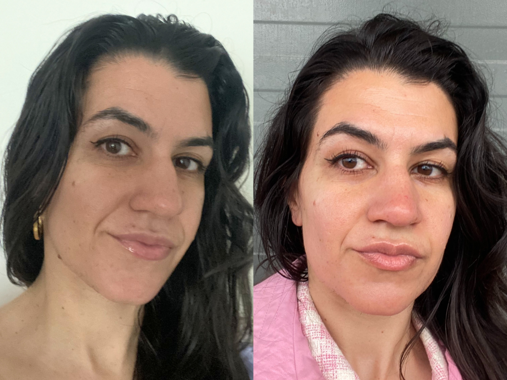 Vanessa before and 5 days after her EverySkin Facial | Space NK Vanessa before and 5 days after her EverySkin Facial | Space NK