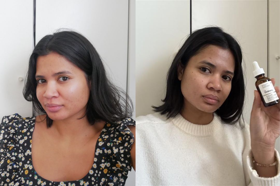 Before and after The Ordinary GF 15% Solution