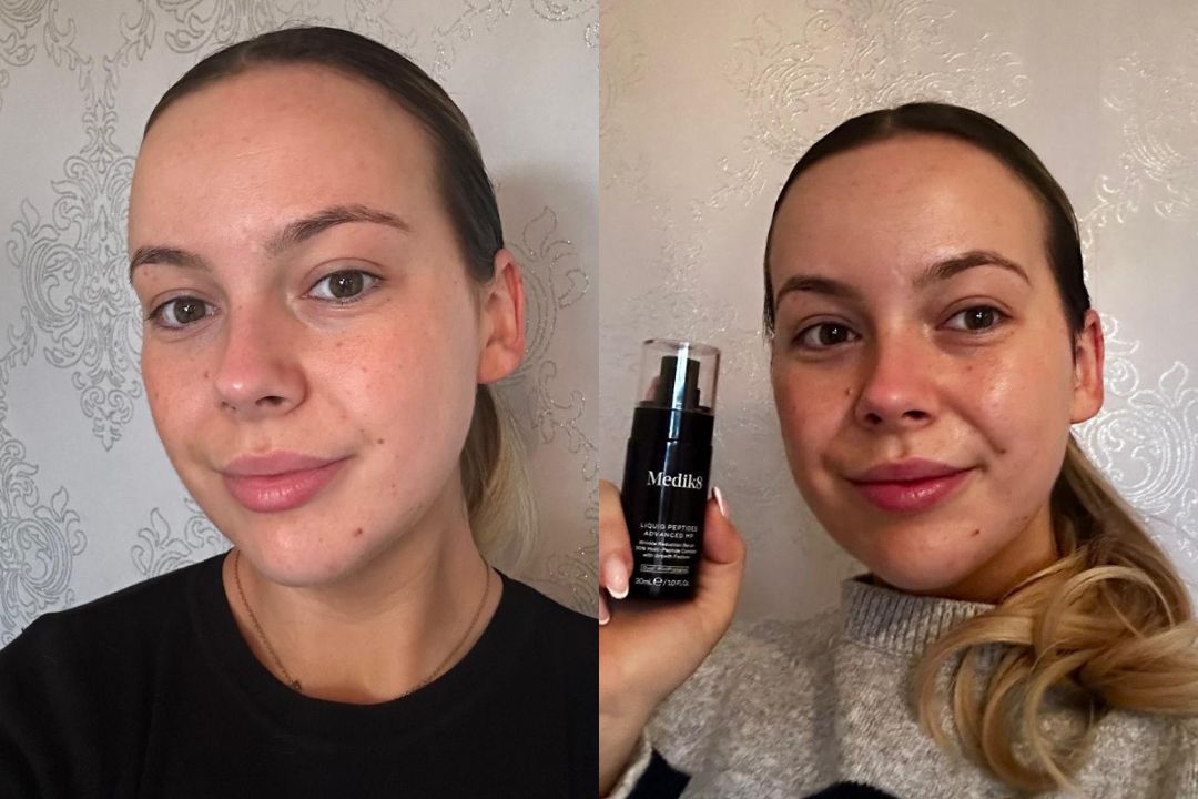 Medik8 Advanced Liquid Peptides before and after 2 weeks Medik8 Advanced Liquid Peptides before and after 2 weeks