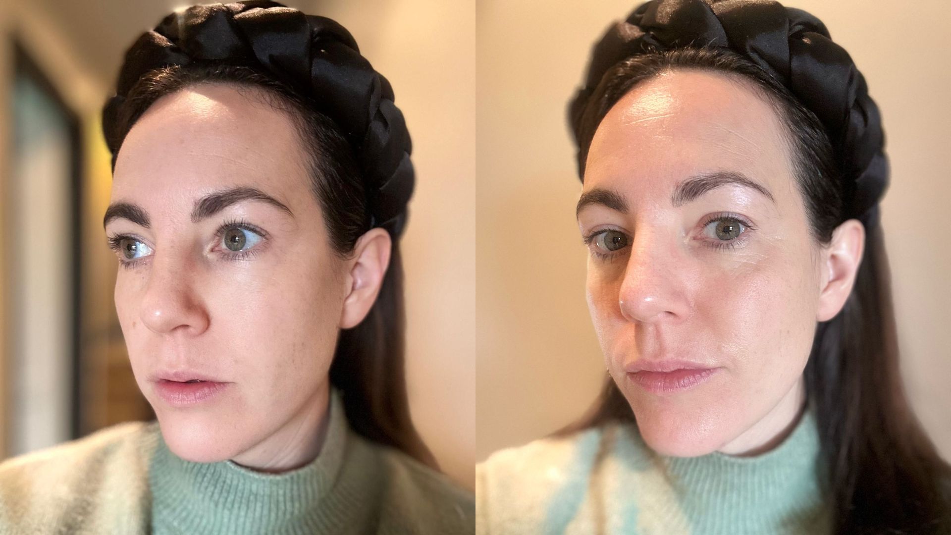 Felicity before and after using The Ordinary Multi-Active Delivery Essence | Space NK Felicity before and after using The Ordinary Multi-Active Delivery Essence | Space NK